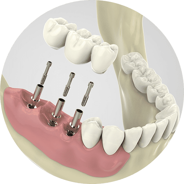 Dental Implants Brisbane | Tooth Replacement | Brisbane Smiles